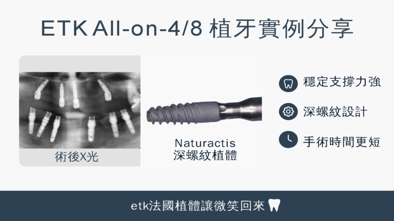 all-on-4-case