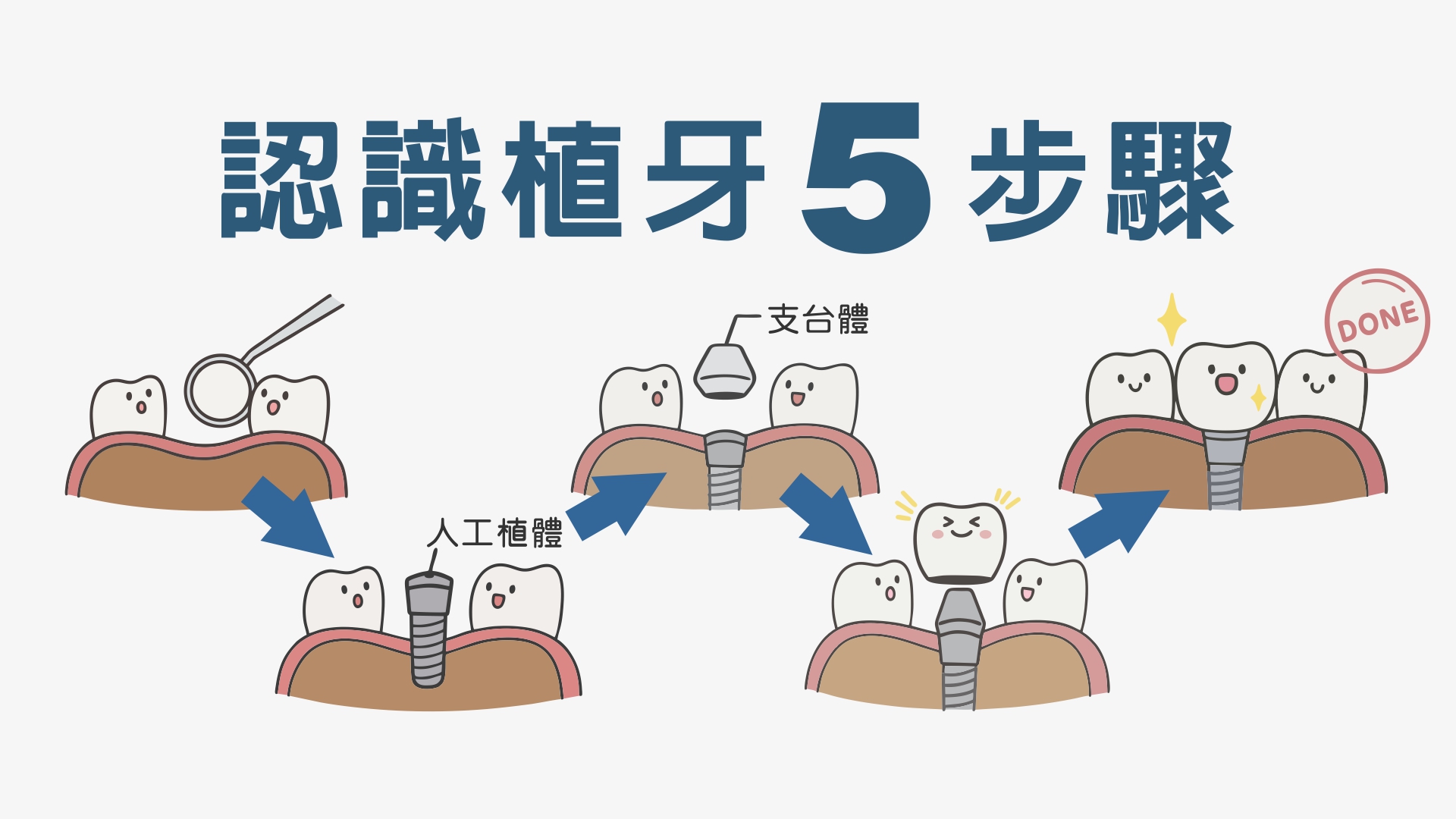 5-dental-implant-process