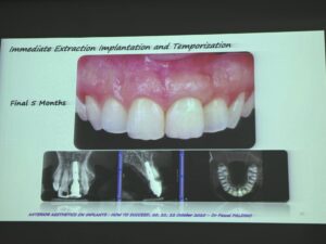 Immediate Extraction Implantation and Temporization